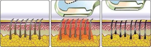 Зона бикини лазерная эпиляция. Особенности удаления волос в интимной зоне