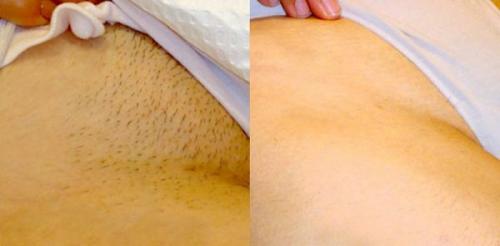 Депиляция воском бикини глубокое. Как выполняется ваксинг зоны бикини