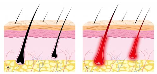 Какой лазер самый эффективный. Принцип действия