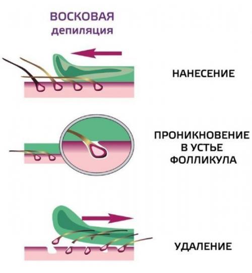 Депиляция воском бикини. Как выполняется ваксинг зоны бикини