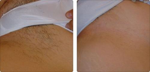 Как брить зону бикини бритвой подростку. Правила бритья бикини