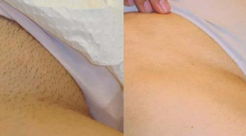 Лазерная эпиляция глубокое бикини: как делают. Преимущества и недостатки