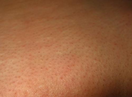 Лазерная эпиляция в качестве основы бикини дизайна. 2008 Девятая процедура лазерной эпиляции 01