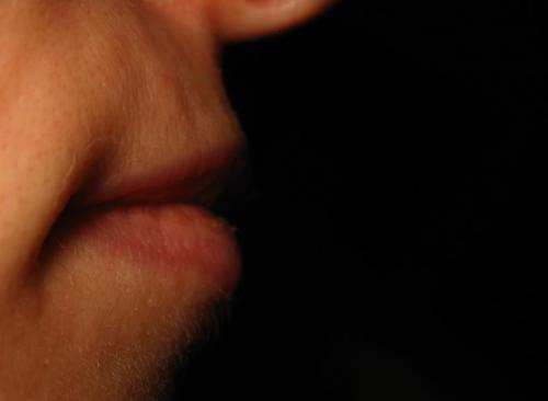 Лазерная эпиляция в качестве основы бикини дизайна. 2008 Девятая процедура лазерной эпиляции 04