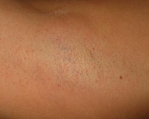 Лазерная эпиляция в качестве основы бикини дизайна. 2008 Девятая процедура лазерной эпиляции 03