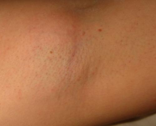 Лазерная эпиляция в качестве основы бикини дизайна. 2008 Девятая процедура лазерной эпиляции 02