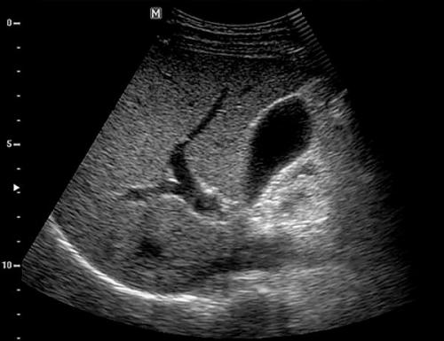 Есть ли противопоказания для использования этих рецептов. Основные противопоказания к применению препаратов на основе алоэ и меда