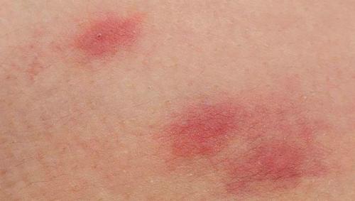 Есть ли противопоказания для использования этих рецептов. Основные противопоказания к применению препаратов на основе алоэ и меда