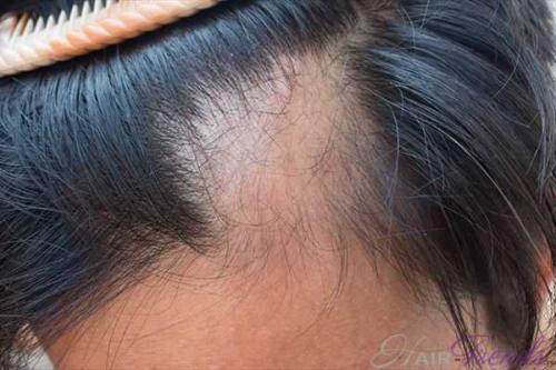 Можно ли наносить луковую маску на кожу головы. Луковый сок против потери волос