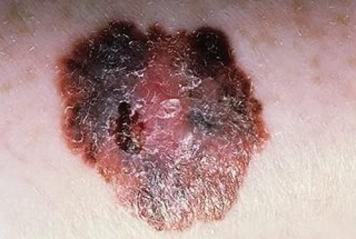 Болезни и аномалии стержней волос. Чем могут быть вызваны болезни волосяного покрова? 08 Болезни и аномалии стержней волос. Чем могут быть вызваны болезни волосяного покрова? 08