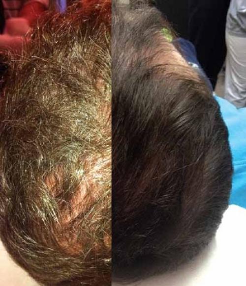 Средства для роста волос для мужчин. Приложение: Использование богатой тромбоцитами плазмы в качестве «одноразовой» альтернативы лечения