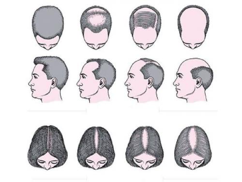 Как вылечить андрогенную аллопецию. Андрогенетическая алопеция 05