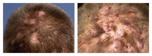 Как вылечить андрогенную аллопецию. Андрогенетическая алопеция 01