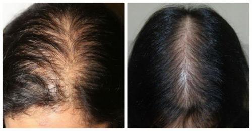 Тугой пучок может стать причиной выпадения волос. Симптомы выпадения волос 01