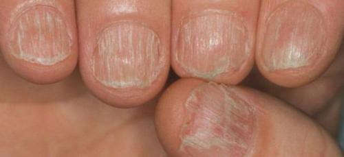 Выпадение волос на теле. Содержание статьи 04