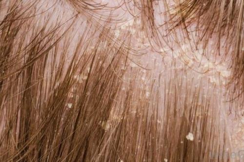 Выпадение волос на затылке у женщин. Диагностика 06