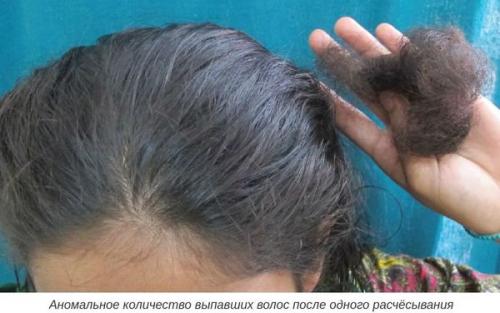 Андрогенетическая алопеция у женщин. Патогенез 01 Андрогенетическая алопеция у женщин. Патогенез 01