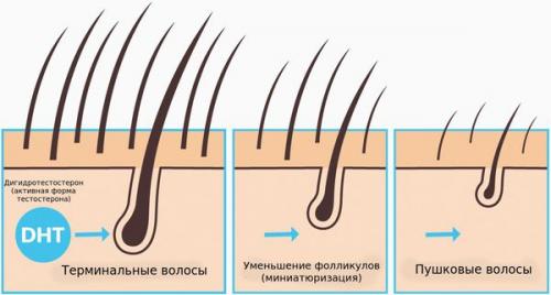 Выпадение волос у женщин, как симптом болезни. Распространенность 02