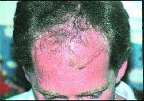 Возрастная алопеция у женщин. Диффузная алопеция у женщин – причины, симптомы и методы лечения 08