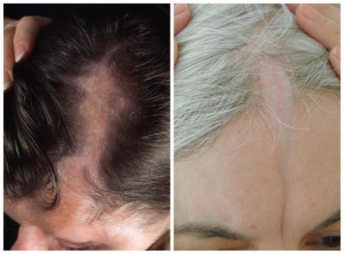 Основные причины гнездной алопеции. Гнездовая алопеция и другие виды облысения 02