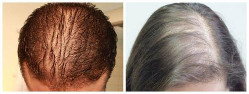 Основные причины гнездной алопеции. Гнездовая алопеция и другие виды облысения 04