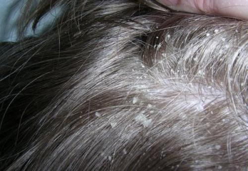 Можно ли использовать уксус для избавления от перхоти и как. Секреты применения яблочного уксуса от перхоти: плюсы и минусы, точные рецепты, использование и результат