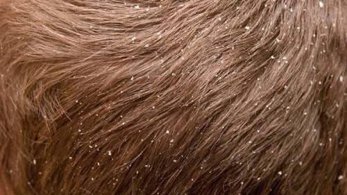 Удаление перхоти за 1 день: эффективные домашние методы 01