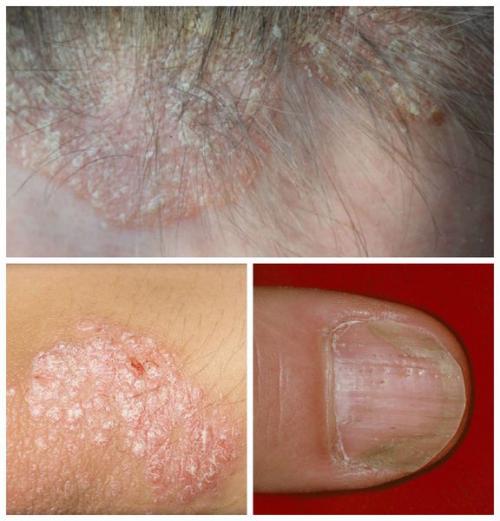 Сухая кожа головы и сухая перхоть: причины и методы лечения 03 Сухая кожа головы и сухая перхоть: причины и методы лечения 03