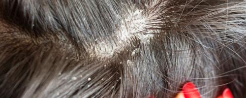 Почему на голове появляется перхоть: основные причины 01