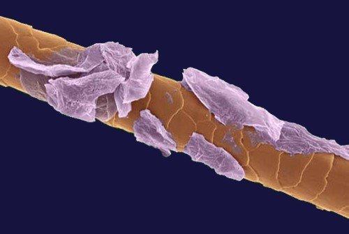 Как предотвратить появление перхоти с помощью народных методов. Народные рецепты от перхоти