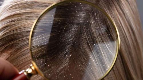 Возможно ли полностью избавиться от перхоти за 5 минут или это временное решение. Отчего появляется перхоть