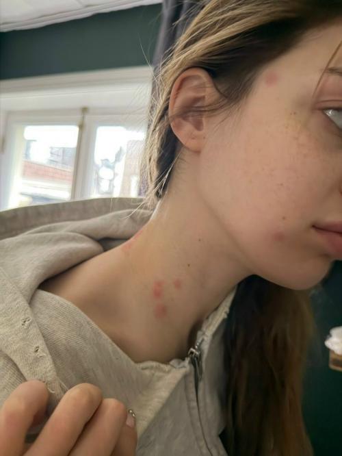 У Ани акулич случилась истерика из-за появления красных пятен на коже. 01