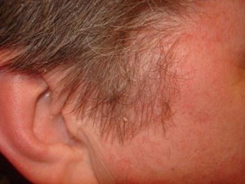 Хронические дерматозы кожи головы: как различать и чем лечить статья@Gazetak якосметолог косметология. 01