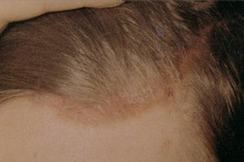 Хронические дерматозы кожи головы: как различать и чем лечить статья@Gazetak якосметолог косметология. 02