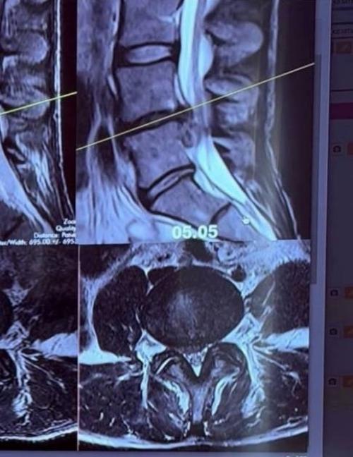 Жена цекало попала в инвалидную коляску после массажа спины. 01