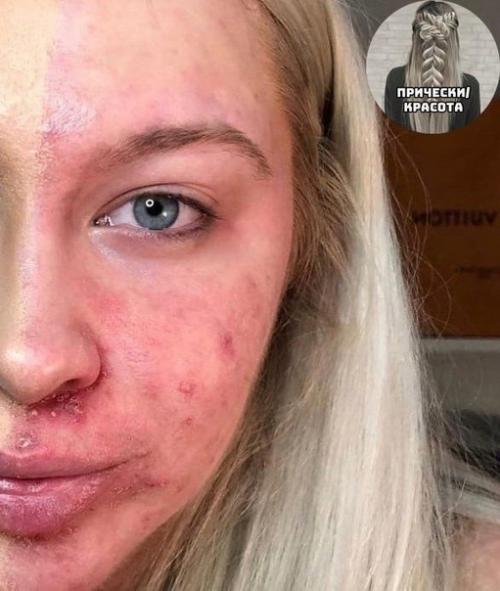 Бедная девочка, тут даже тональник не помогает. 01