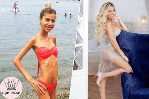 Маша кохно поборола анорексию! 03