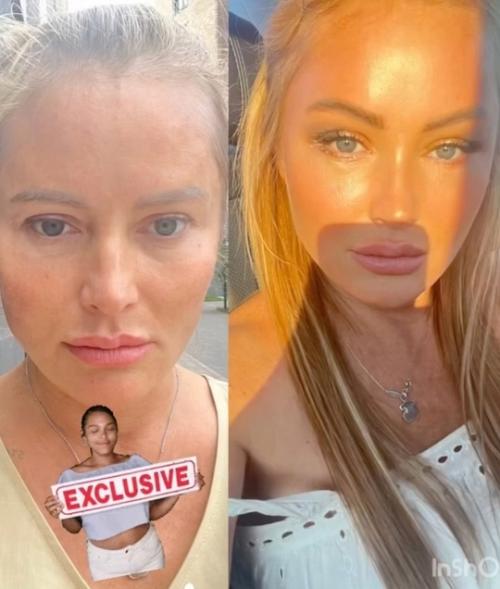 Дана Борисова хвастается Лисьими Глазками через 10 дней после операции. 01