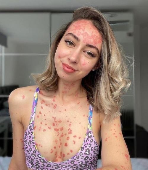 Раньше люди боялись из дому показаться с таким диагнозом, а сейчас ещё и деньги на этом зарабатывают. 01