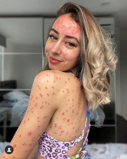 Раньше люди боялись из дому показаться с таким диагнозом, а сейчас ещё и деньги на этом зарабатывают. 03