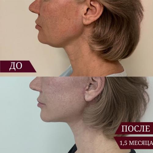 Снова подтянутая шея, четкий подбородок и никаких Брылей? 04