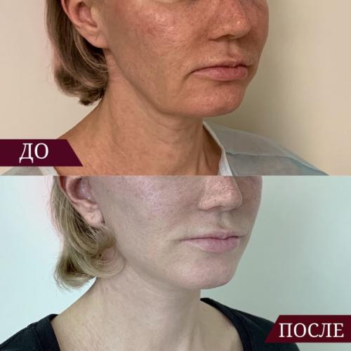 Снова подтянутая шея, четкий подбородок и никаких Брылей? 02