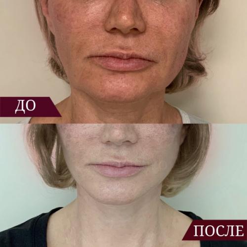 Снова подтянутая шея, четкий подбородок и никаких Брылей? 01