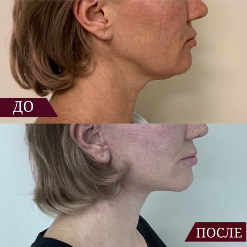 Снова подтянутая шея, четкий подбородок и никаких Брылей? 03