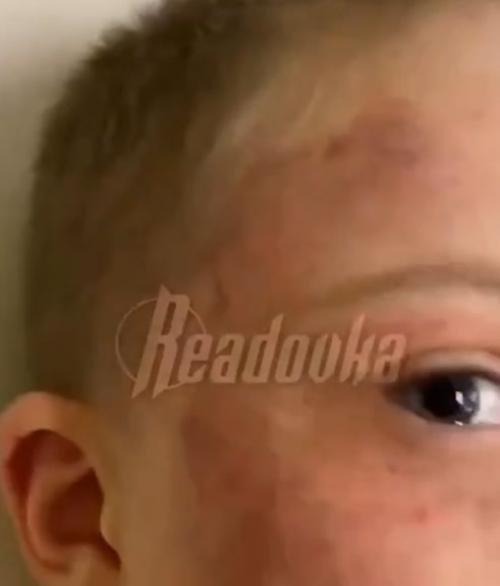 Ребенок на грани: один день в школе и на лице нет места целого. 01