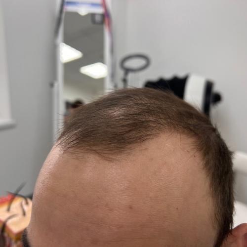 Реклама волшебных препаратов, которые обещают раз и навсегда решить и остановить андрогенную алопецию - не существует! 03