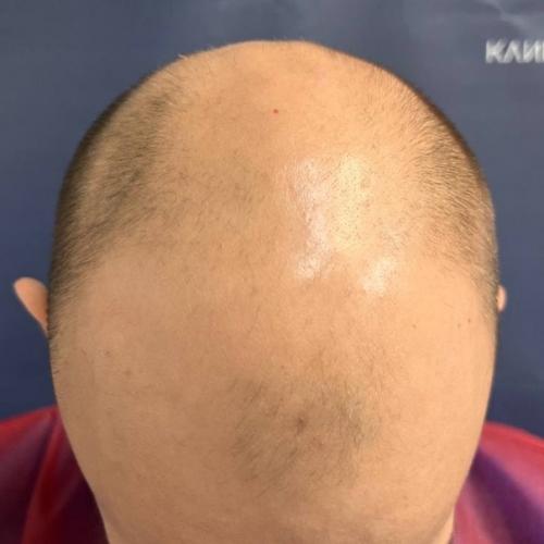 Реклама волшебных препаратов, которые обещают раз и навсегда решить и остановить андрогенную алопецию - не существует! 01