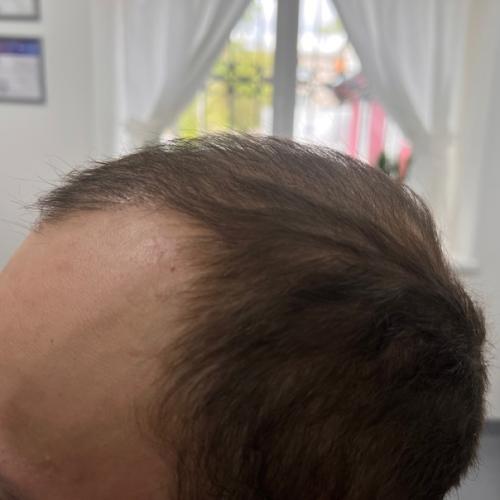 Реклама волшебных препаратов, которые обещают раз и навсегда решить и остановить андрогенную алопецию - не существует! 04