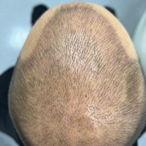 Реклама волшебных препаратов, которые обещают раз и навсегда решить и остановить андрогенную алопецию - не существует! 02