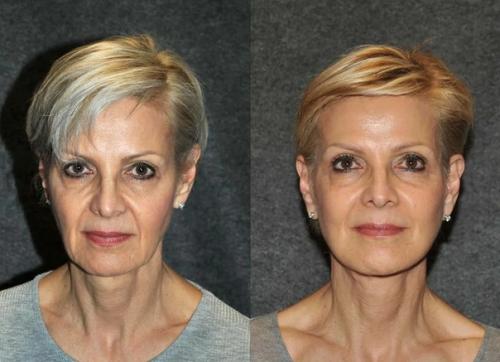 Как выглядят обычные женщины 50-70 лет, сделавшие подтяжку лица. 01